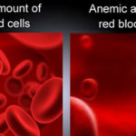 anemia cause