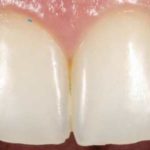 microgranuli denti dentifrici