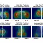 Rilevazione cancro al seno con Intelligenza Artificiale Radiology