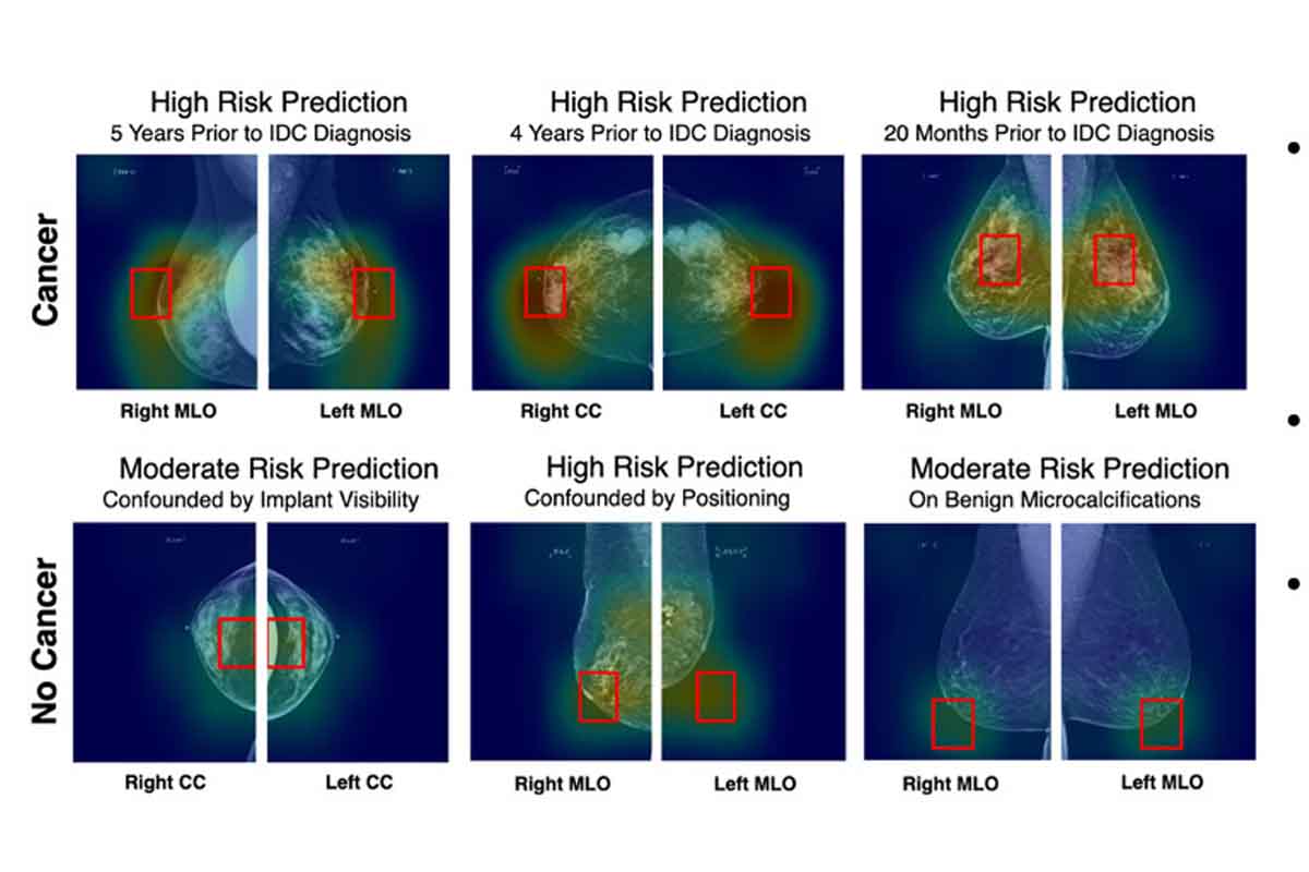 Rilevazione cancro al seno con Intelligenza Artificiale Radiology